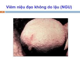 Viêm niệu đạo không do lậu (NGU) - Hình ảnh minh họa